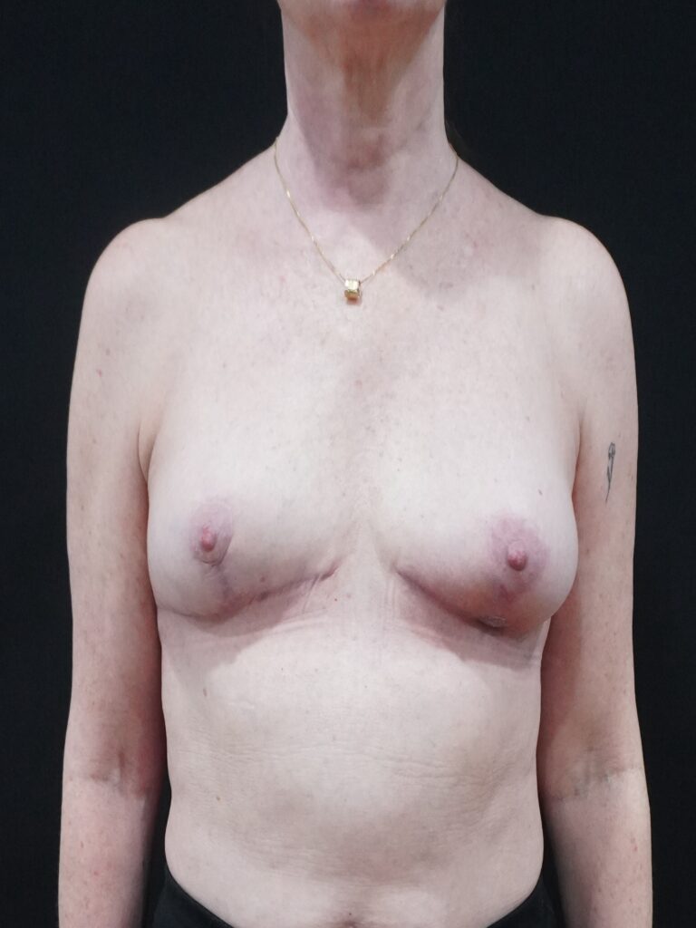 After Image:  - front
