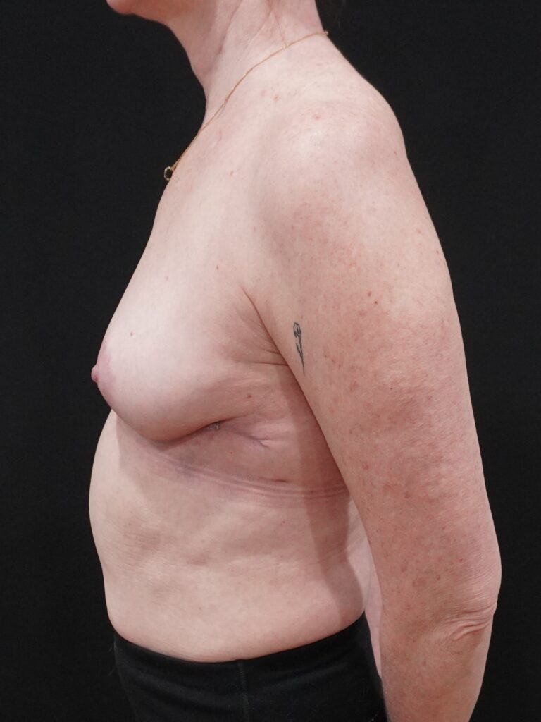 After Image:  - left-side