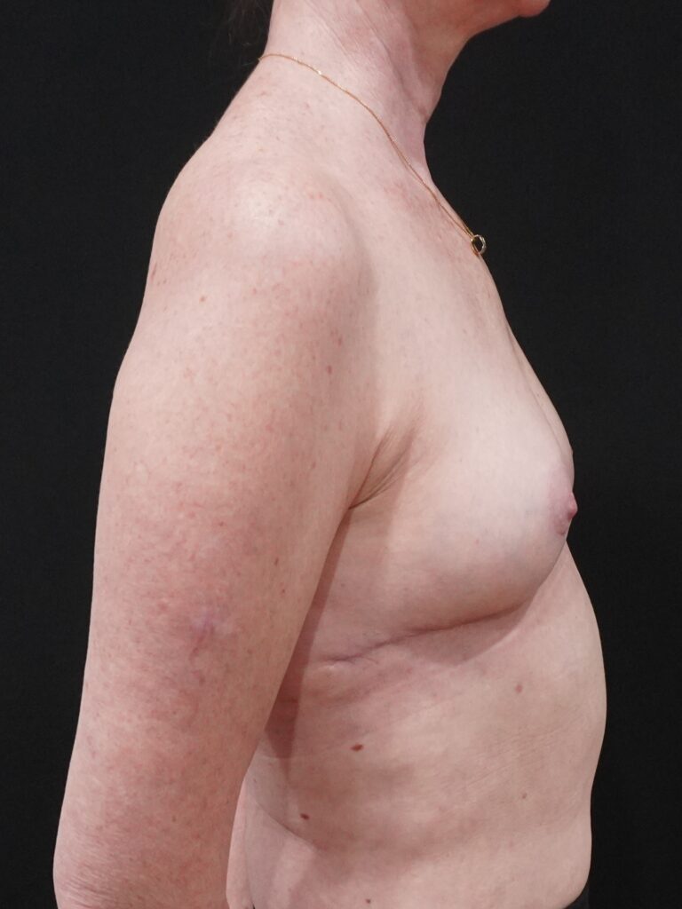 After Image:  - right-side