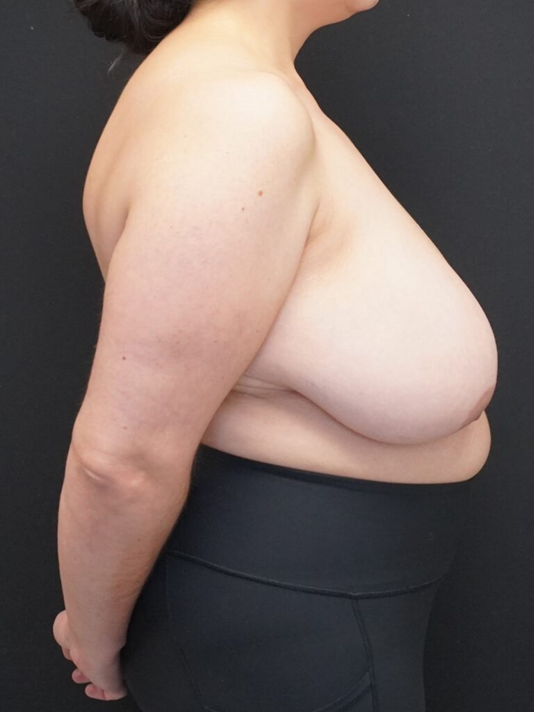Before Image:  - right-side