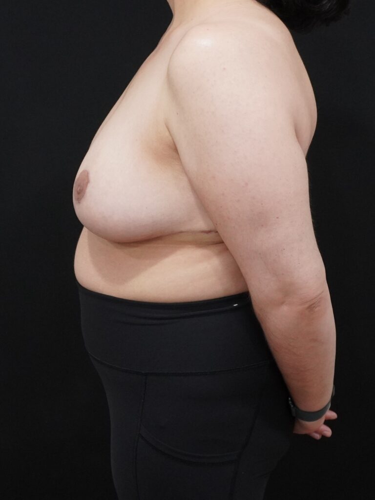 After Image:  - left-side