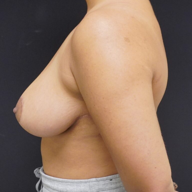 After Image:  - left-side