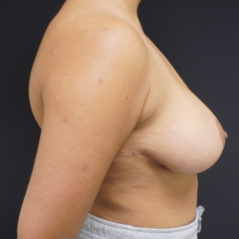 After Image:  - right-side