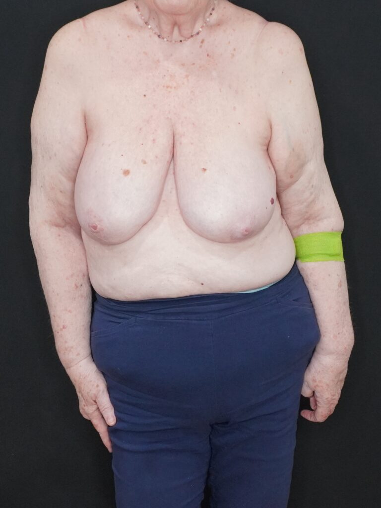 Before Image:  - front