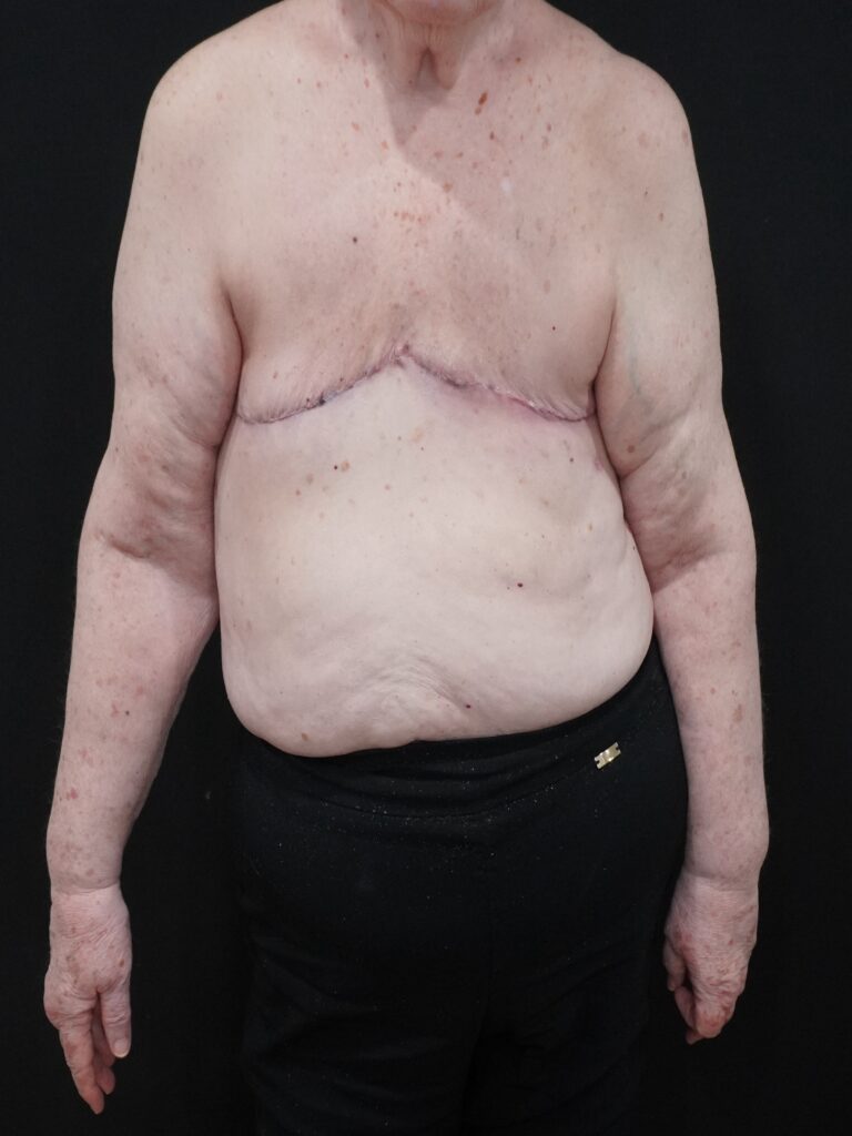 After Image:  - front