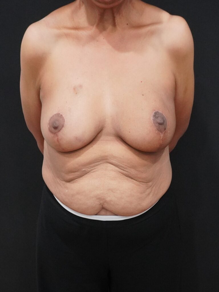 After Image:  - front