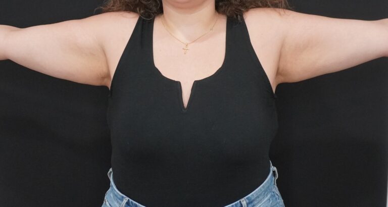 Before Image:  - front