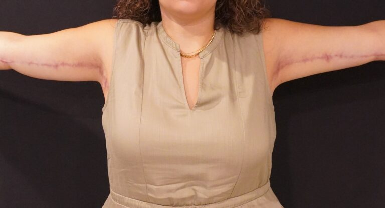 After Image:  - front