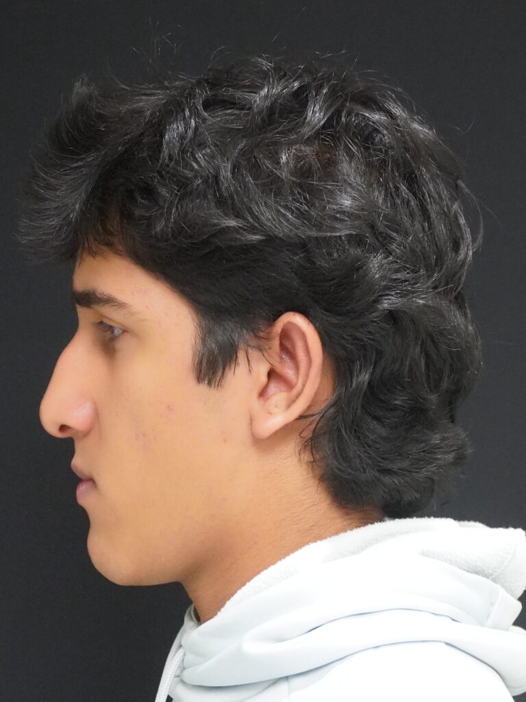 After Image:  - left-side