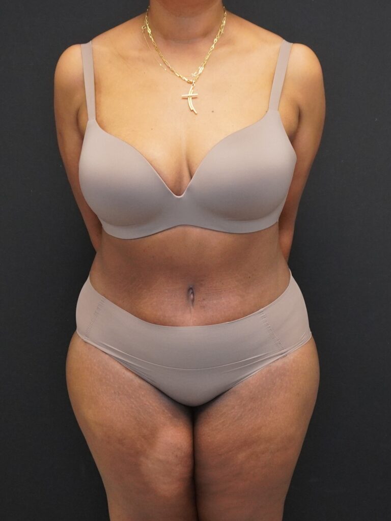After Image:  - front