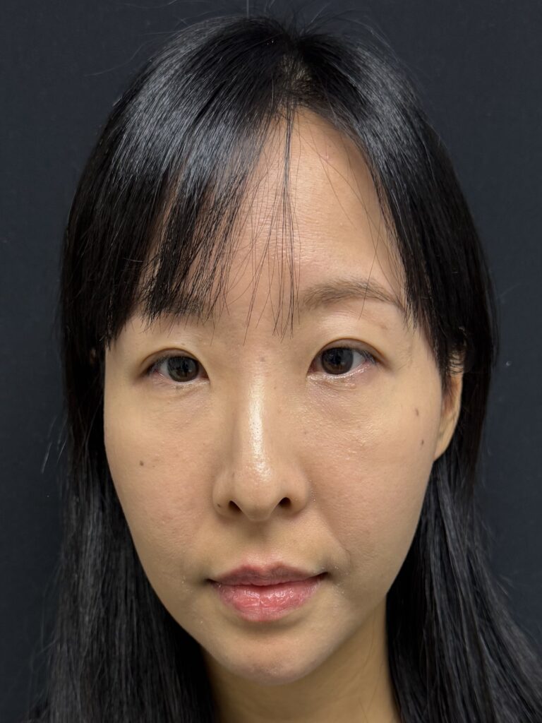 After Image:  - front