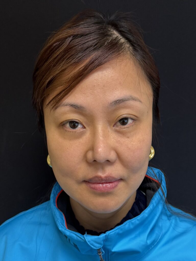 After Image:  - front