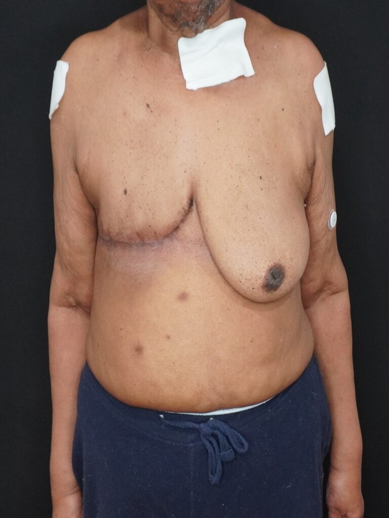 After Image:  - front