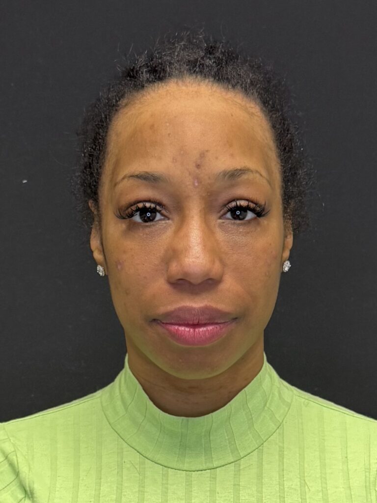 Before Image:  - front