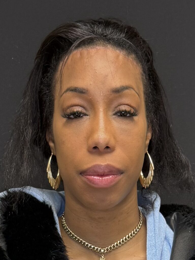 After Image:  - front