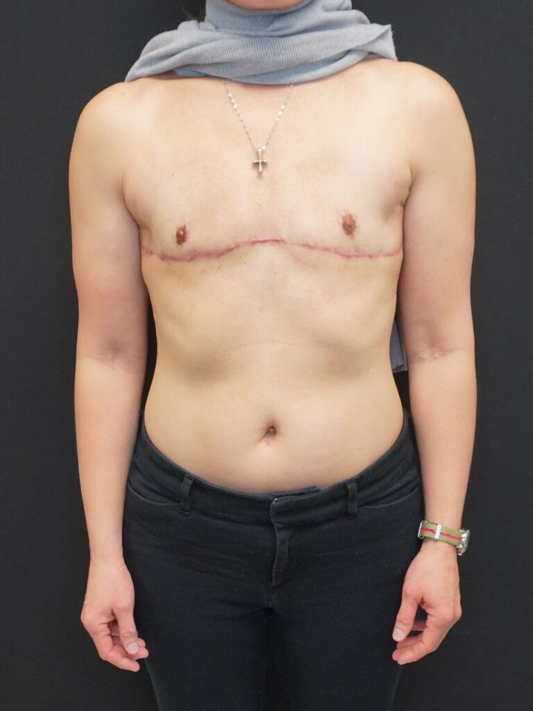 After Image:  - front