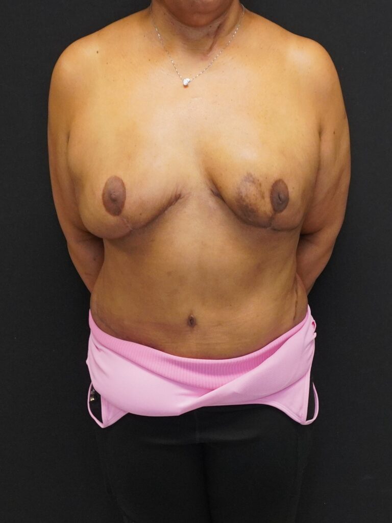 After Image:  - front