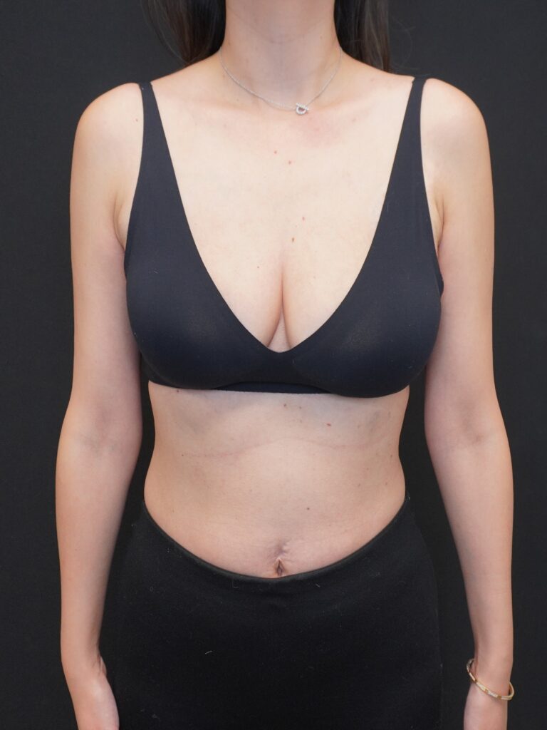 Before Image:  - front