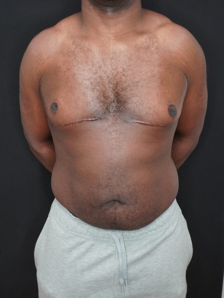 After Image:  - front