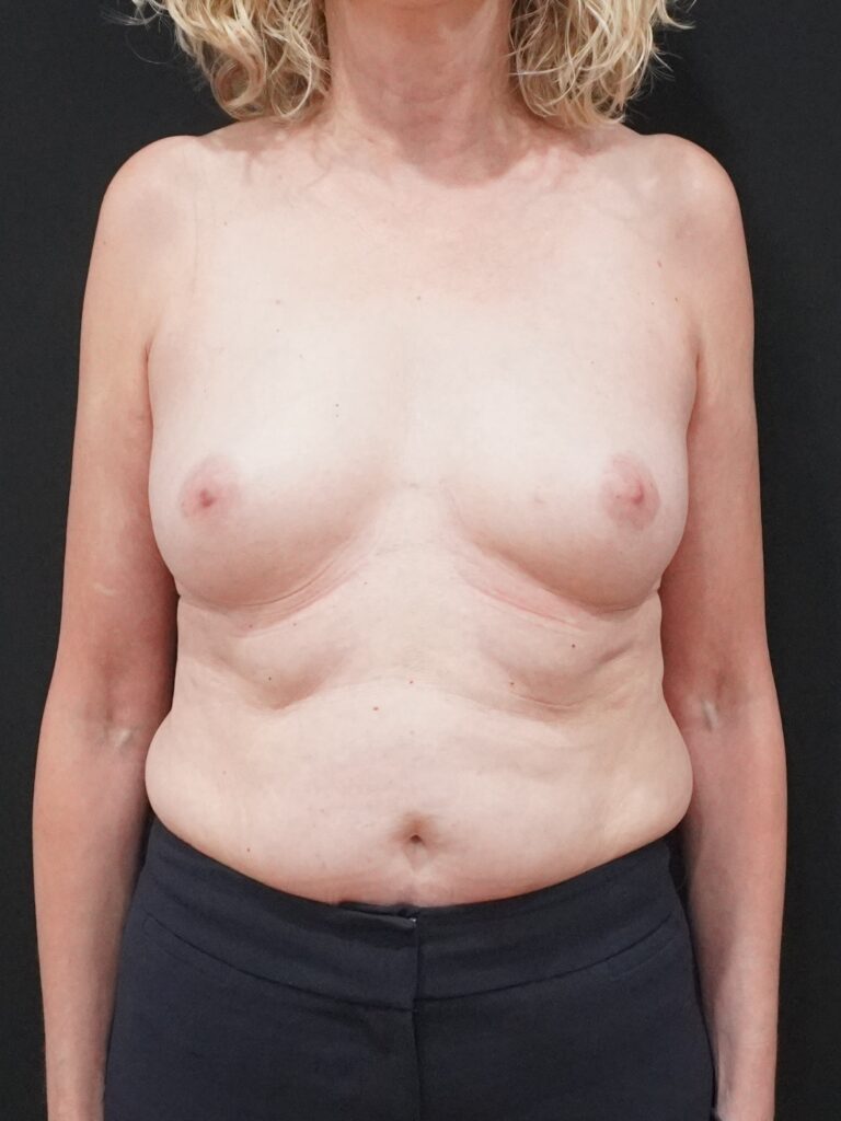 Before Image:  - front