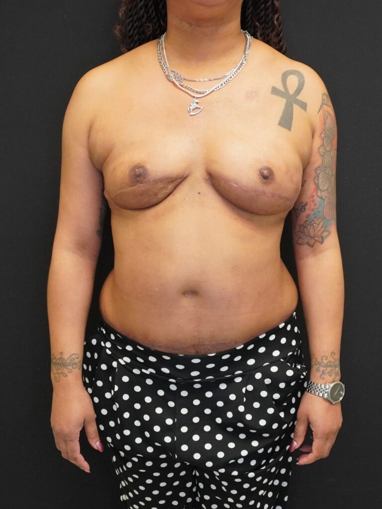 After Image:  - front