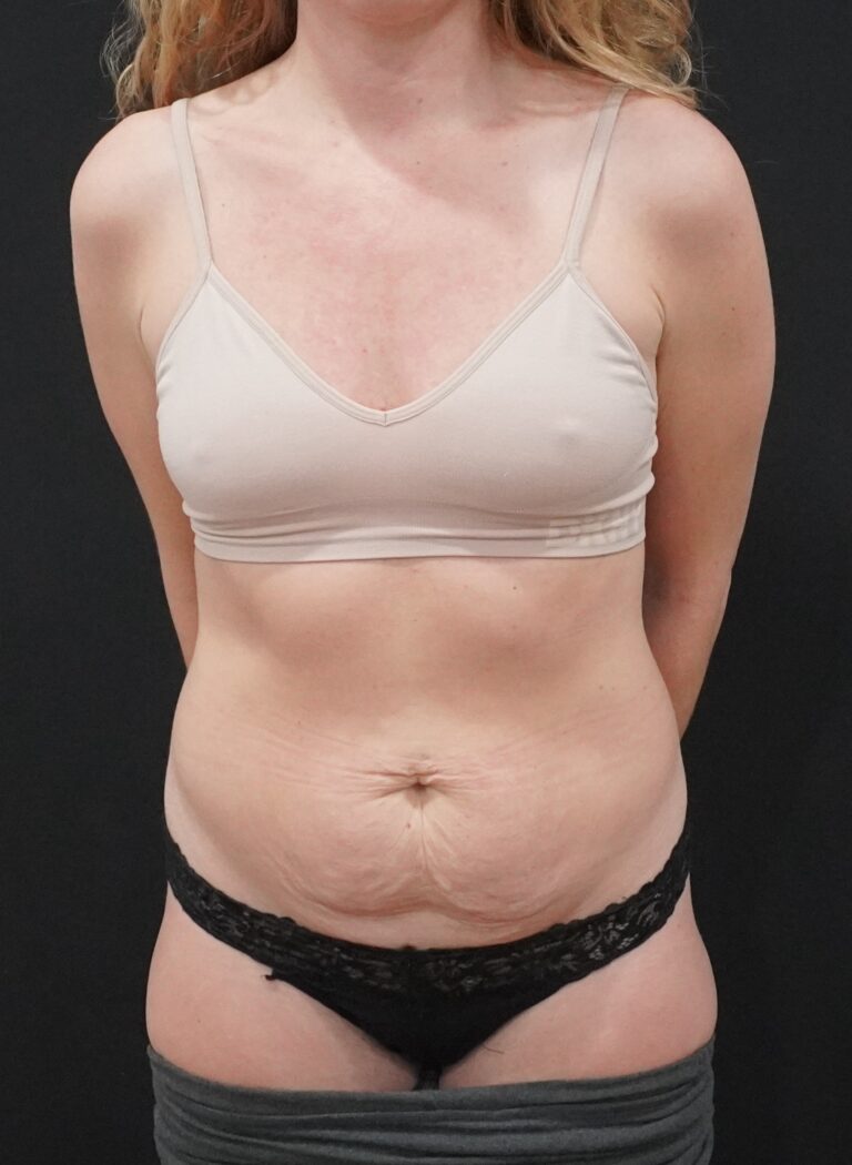 Before Image:  - front