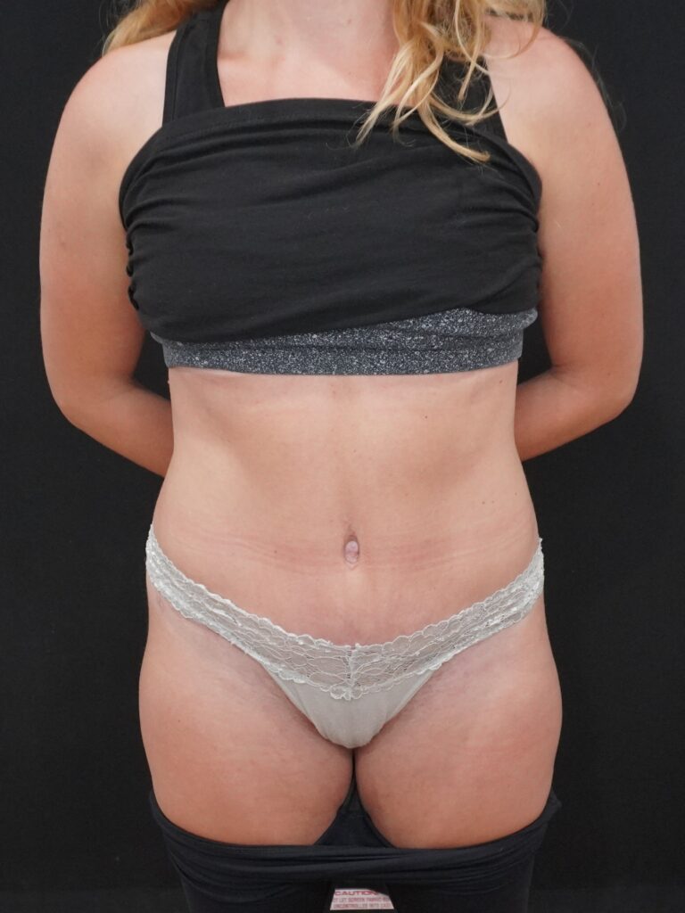 After Image:  - front
