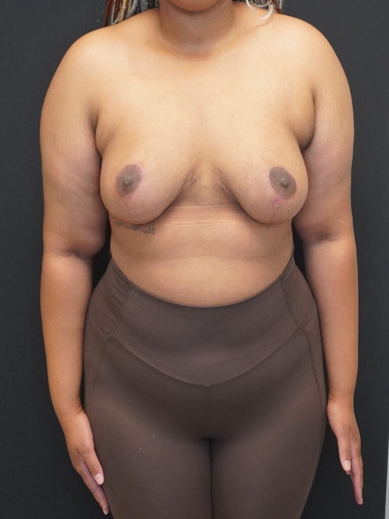 After Image:  - front