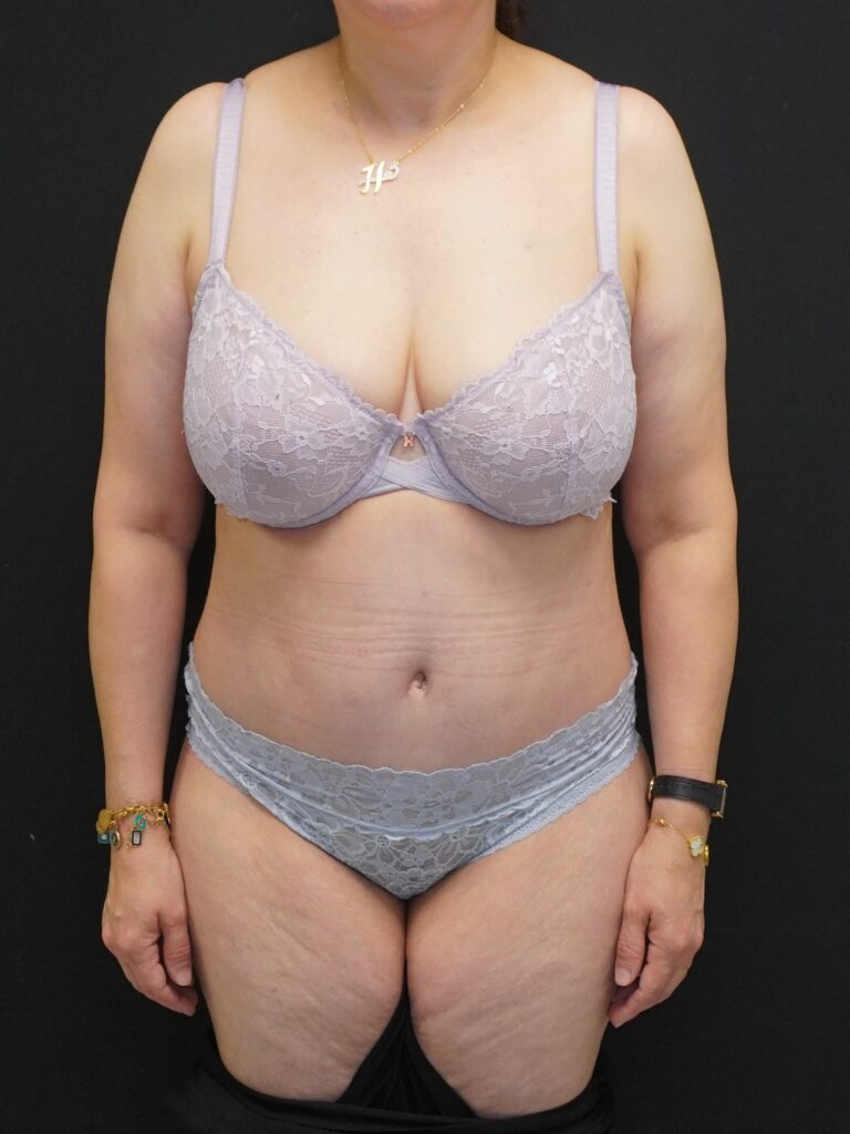 After Image:  - front