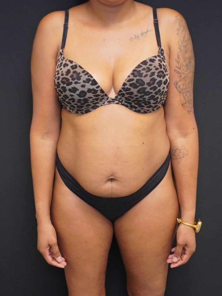 Before Image:  - front