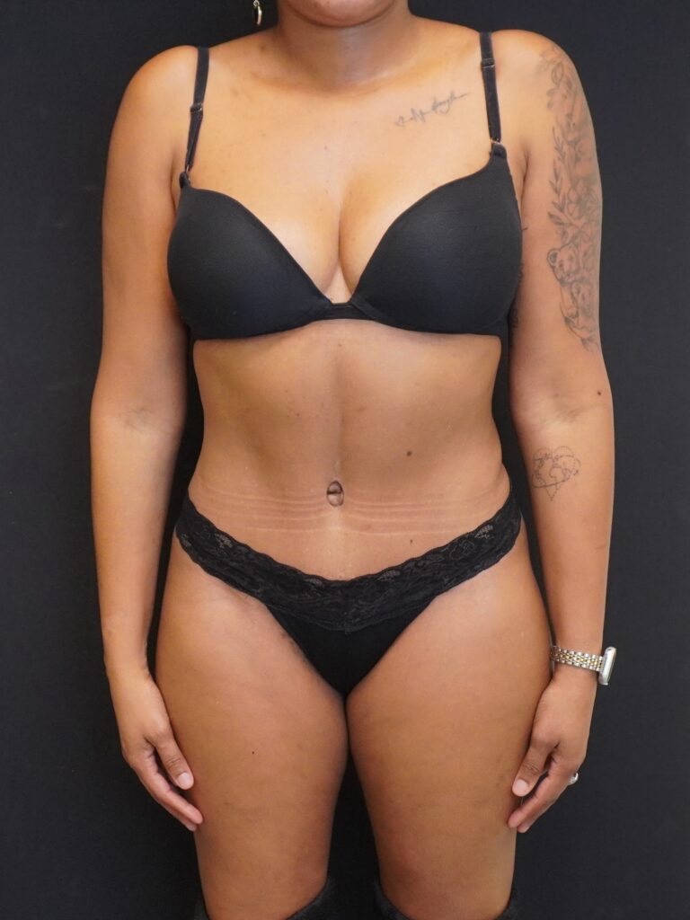 After Image:  - front