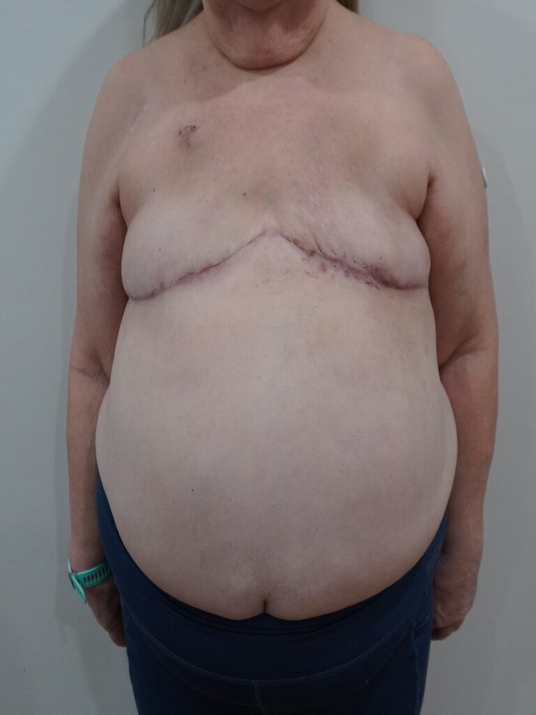 After Image:  - front