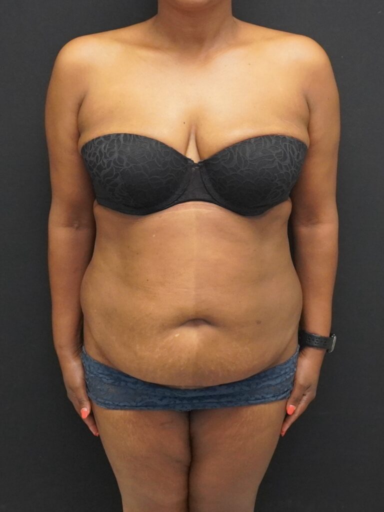 Before Image:  - front