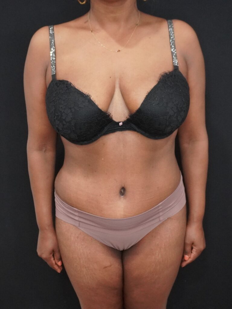 After Image:  - front